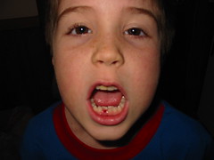Edmund's first lost tooth
