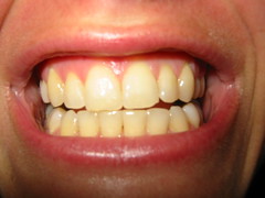 teeth (before)